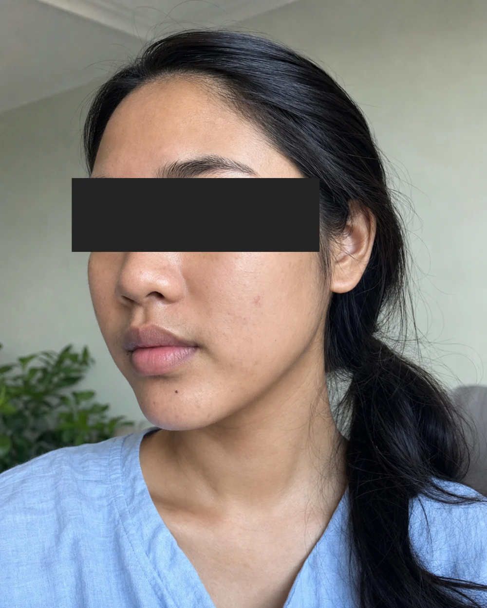 Kulit setelah Acne Facial