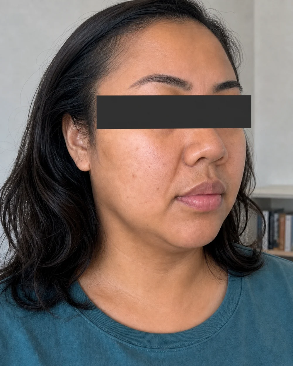 Kontur bawah dagu setelah Mesolipo Double Chin
